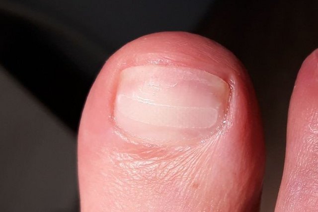 Grosszehennagel mit aufgeklebter Klebe-Nagelspange aus Fiberglas