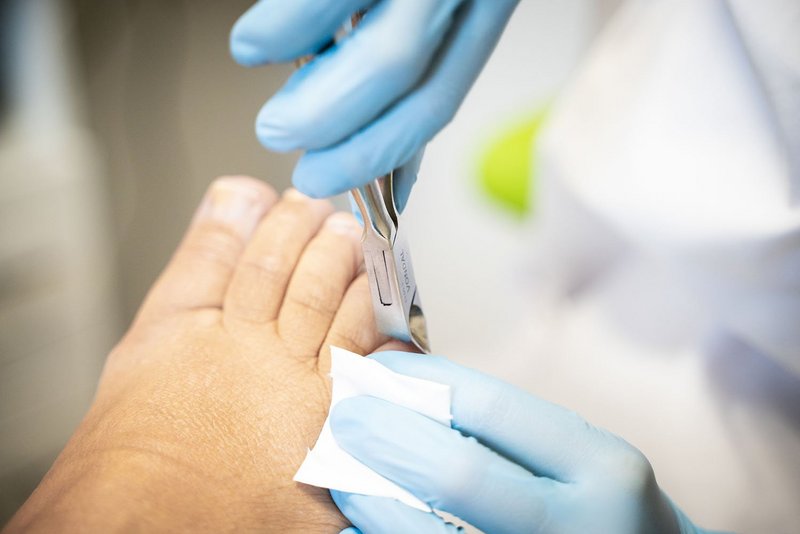 Podologin behandelt mit Handschuhen und Zange den Zehennagel einer Patientin — Nahaufnahme ohne Gesichter
